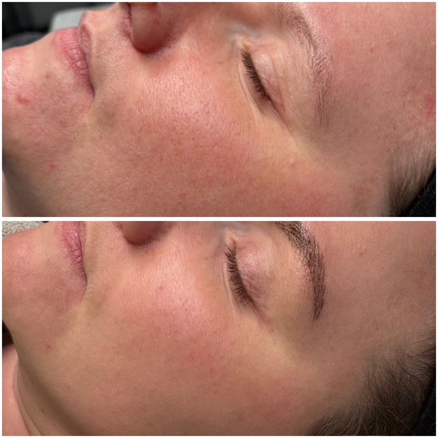 Microneedling
