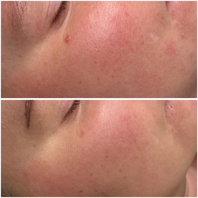 Microneedling