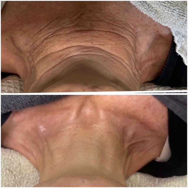 Beyond Peeling