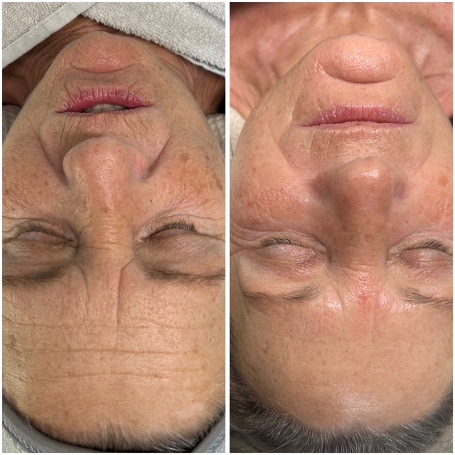 Beyond Peeling