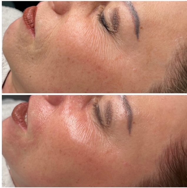 Behandlungsergebnis Anti-Aging Rosa Maria Cosmetics