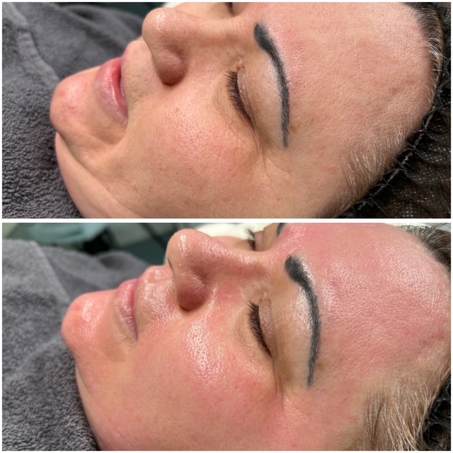 Microneedling