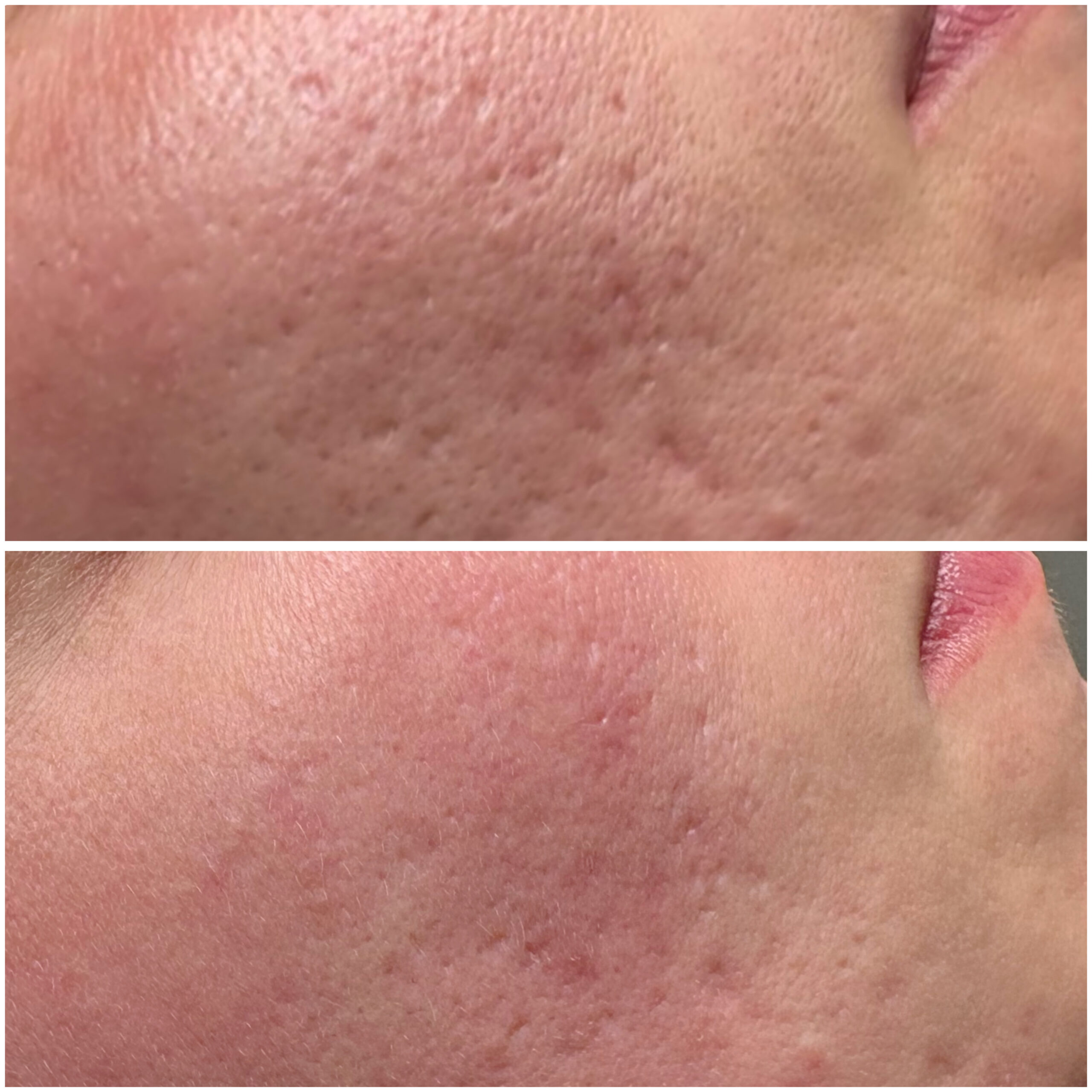 Microneedling Ergebnis Rosa Maria Cosmetics