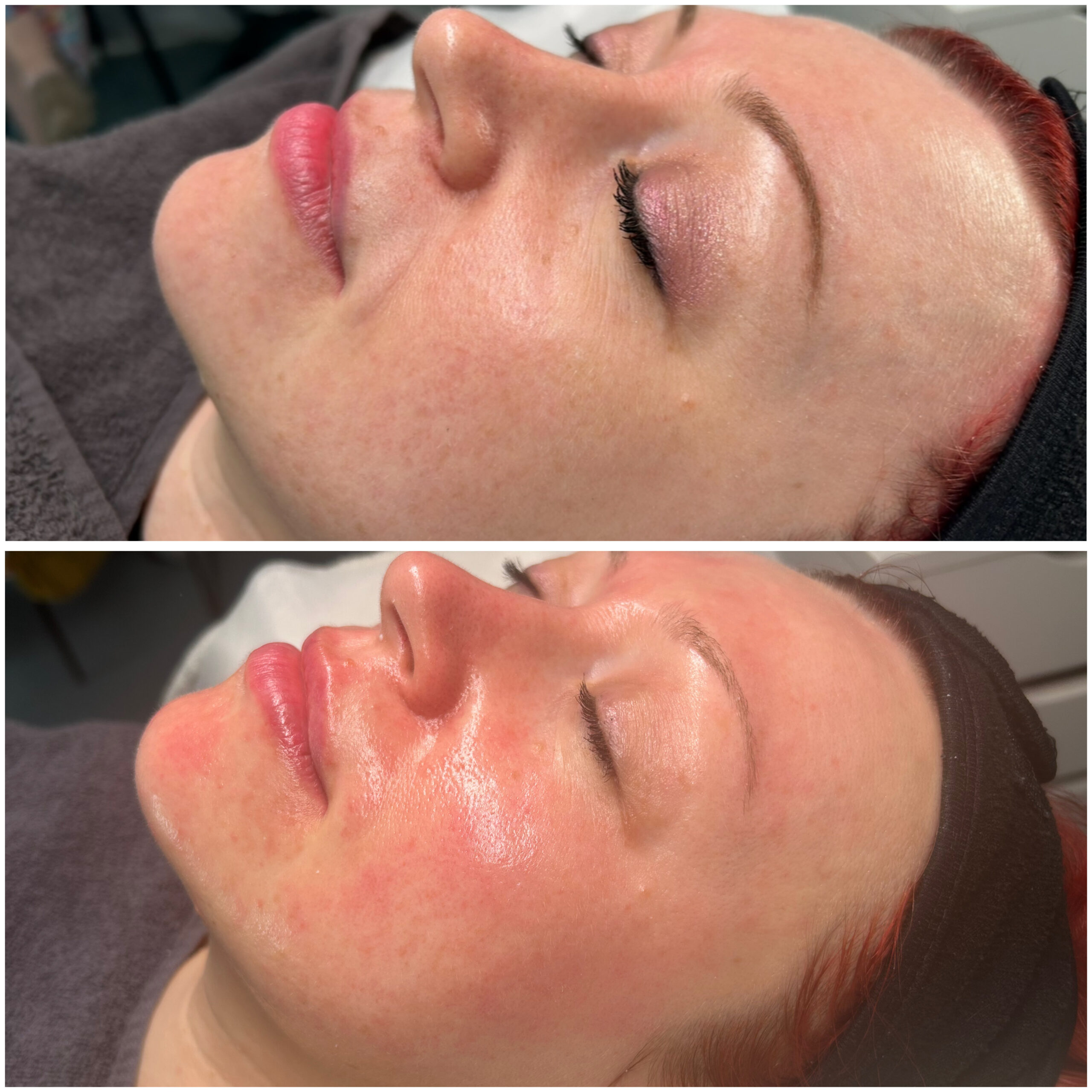 Microneedling Ergebnis Rosa Maria Cosmetics