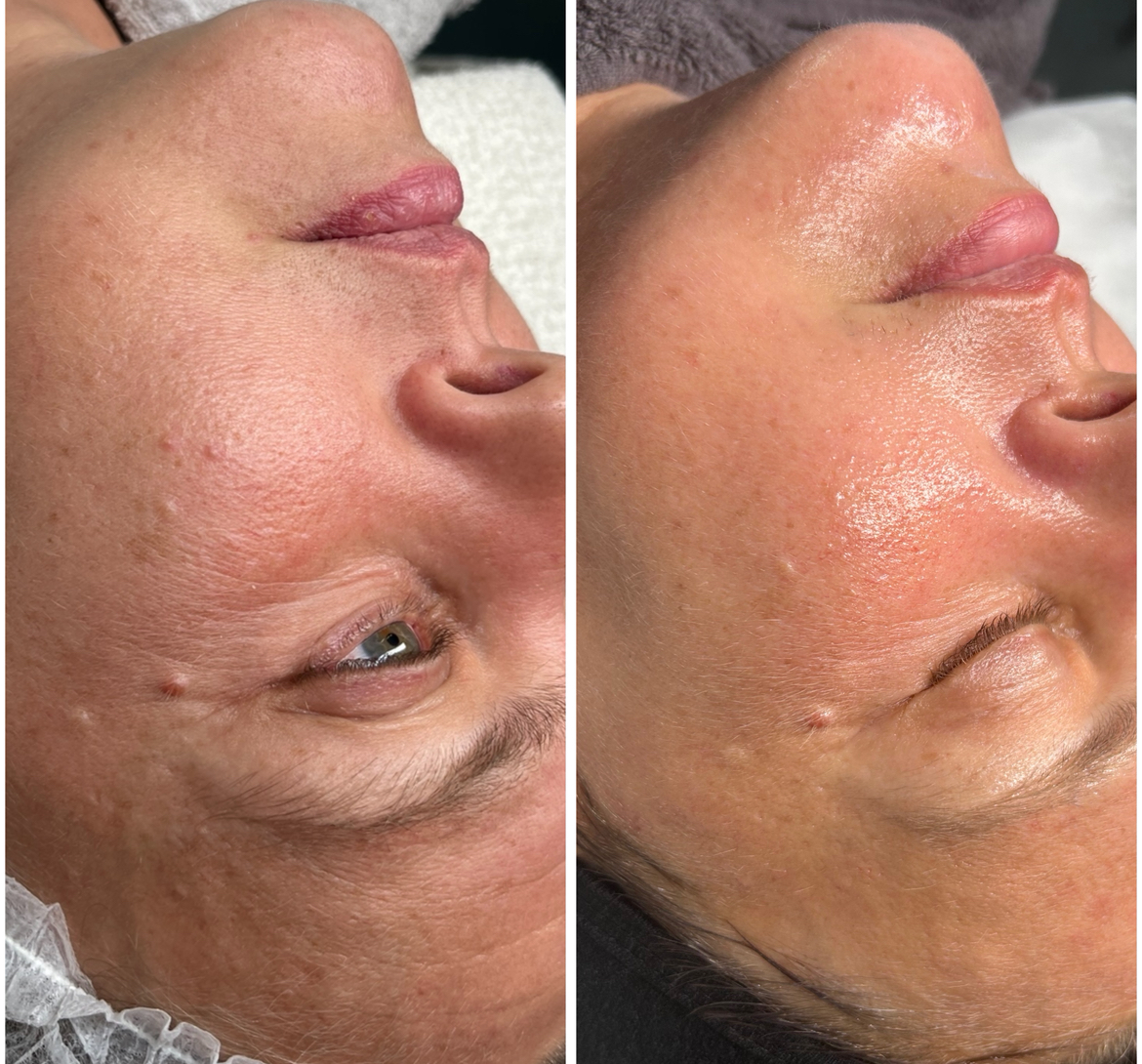 Microneedling